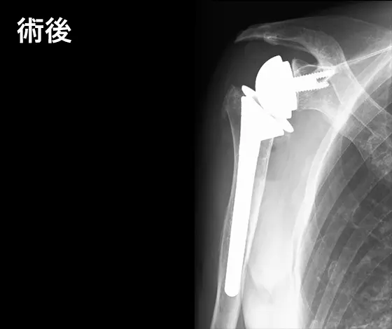 人工肩関節手術の例:術後