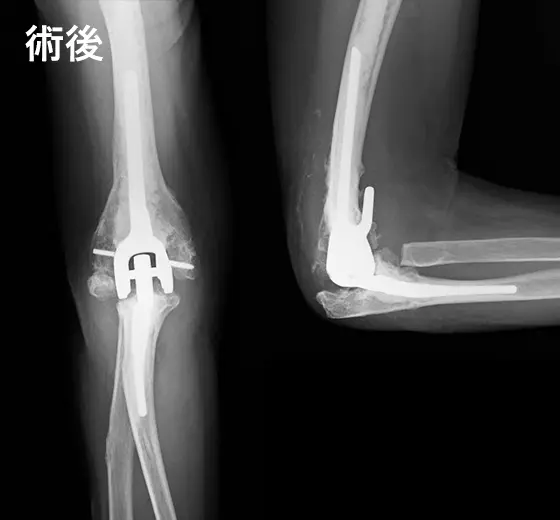 人工肘関節手術の例:術後