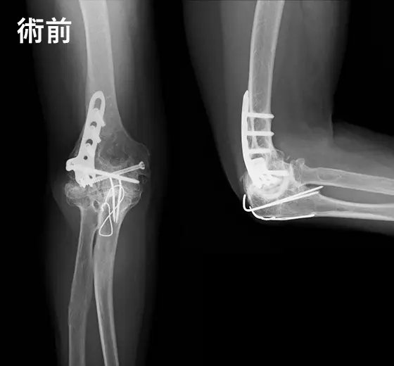 人工肘関節手術の例：術前