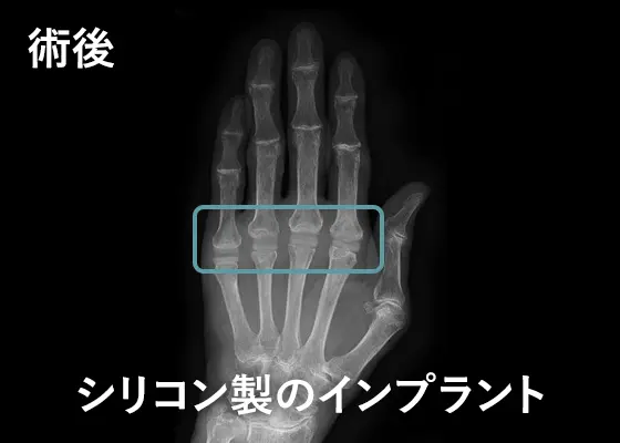 人工指関節手術の例:術後