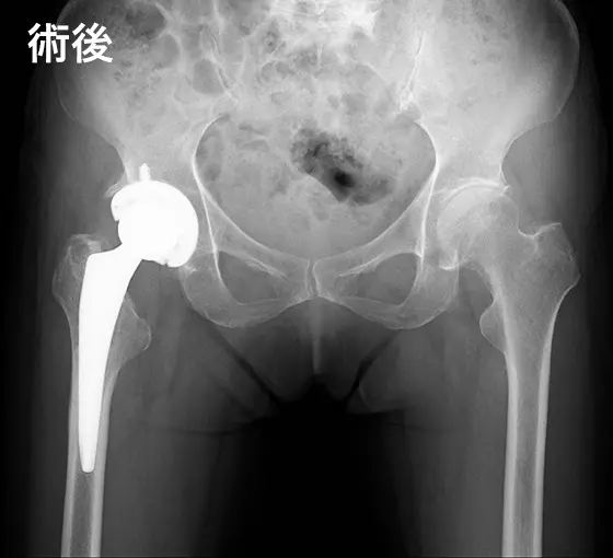 人工股関節手術の例:術後