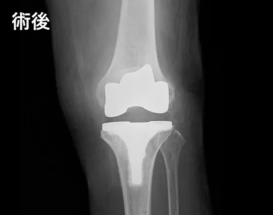 人工膝関節手術の例:術後