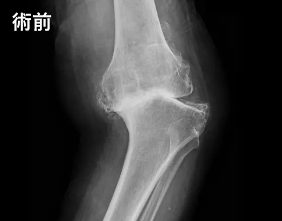 人工膝関節手術の例:術前